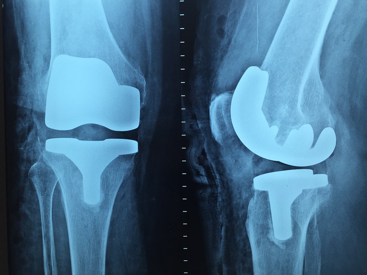 x-ray of an implant, including the femoral and tibial components of a total knee replacement