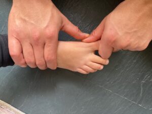 demonstrating a mobilization to help correct a bunion