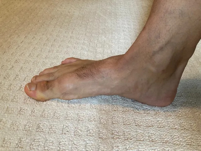 ending position of the arch doming exercise to work intrinsic muscles of the foot